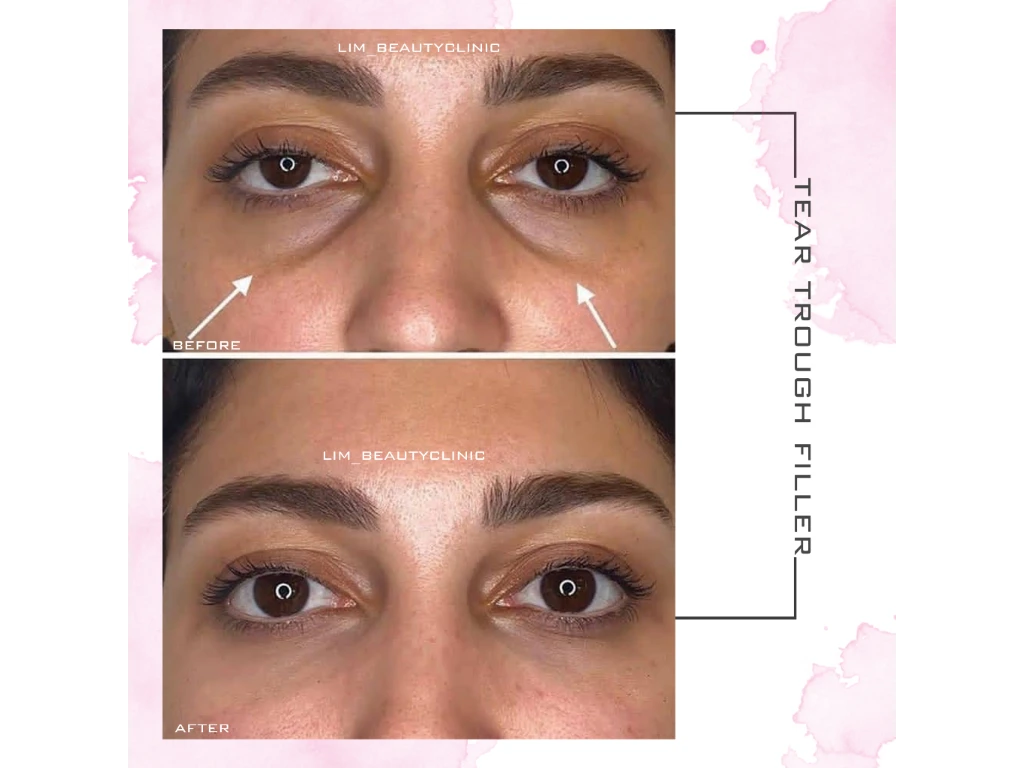 تزرسق فیلر زیر چشم جهت از بین بردن گودی زیر چشم 
نکته:فیلر زیرچشم تا 80 درصد گودی رو از بین میبره 
نکته2:درصورت تیره بودن پوست زیر چشم بهتره از کرم های مربوطه استفاده کنید 