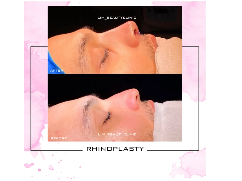 نمونه جراحی بینی برای پسر خوشتیپمون 

جراحی بینی توسط متخصص گوش،حلق،بینی
با بیش از 10 سال تجربه در این زمینه 
و بالای 5000 عمل موفق

برای دیدن نمونه های بیشتر پیج اینستاگراممون رو چک کنید 
ایدی اینستاگرام:lim_beautyclinic