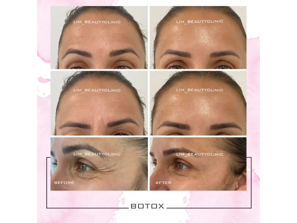 بوتاکس پیشانی جهت رفع چروک های اطراف چشم و پیشانی 

محدودیت سنی نداره
درصورت داشتن فشار خون حتما قبل تزریق به دکتر اعلام کنید
مراقبت های بعد از تزیق بسیار راحت هستن و تا 24 ساعت لازم الاجرا هستن 
برای دیدن نمونه های بیشتر پیج اینستاگراممون رو چک کنید:lim_beautyclinic